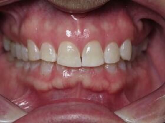 Full Mouth Rehabilitation Case 3 - Before