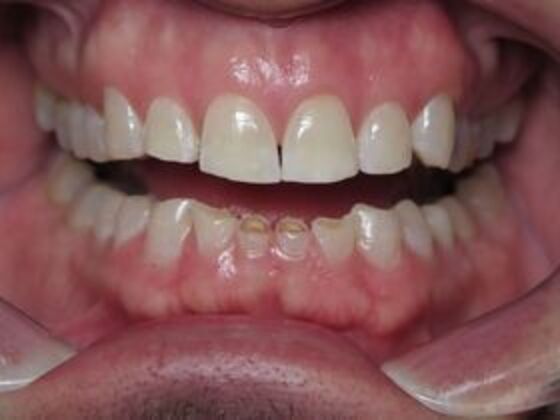 Full Mouth Rehabilitation: Case 3 - Before
