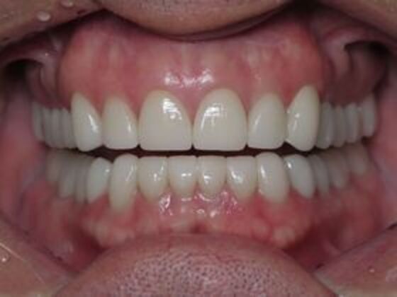Full Mouth Rehabilitation: Case 3 - After