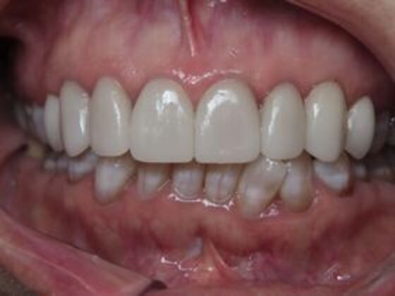 Veneers Case 6 - After