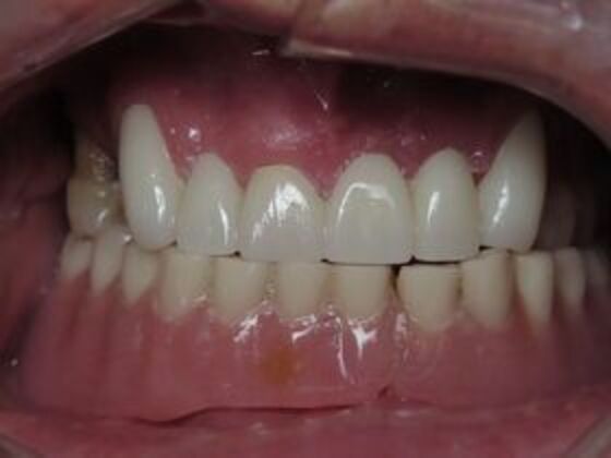 Bridges Case 2 - After