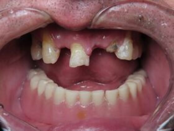 Bridges Case 2 - Before