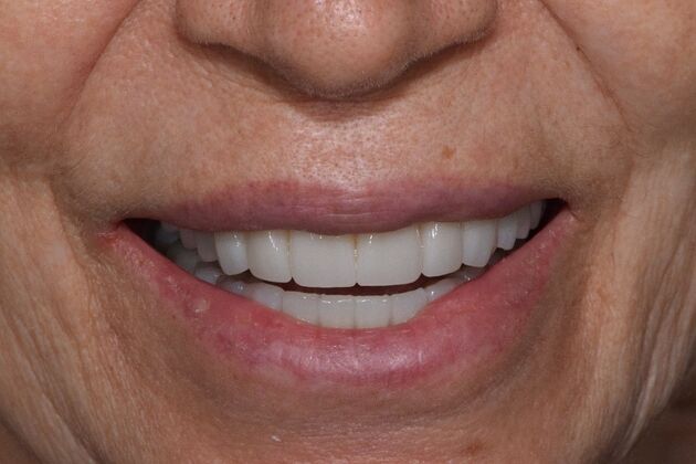 Before and Afters  Case 11 - After