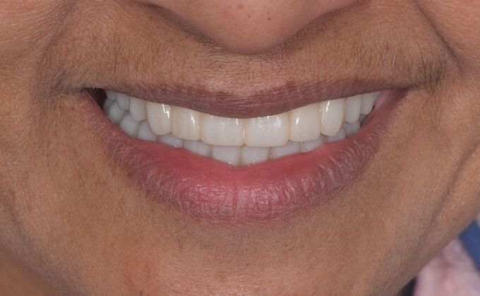 Before and Afters  Case 12 - After