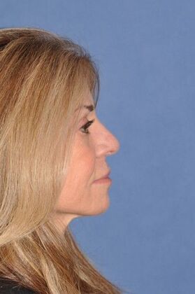 Rhinoplasty: Revision rhinoplasty in woman - Before