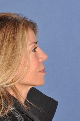 Rhinoplasty: Revision rhinoplasty in woman - After