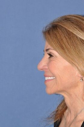 Rhinoplasty: Revision rhinoplasty in woman - Before