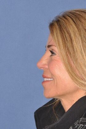 Rhinoplasty: Revision rhinoplasty in woman - After