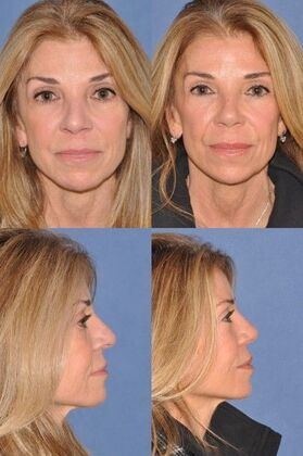 Rhinoplasty: Revision rhinoplasty in woman