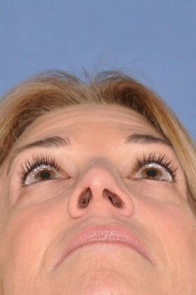 Rhinoplasty: Revision rhinoplasty in woman - Before