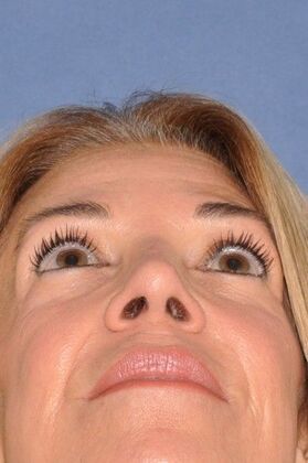 Rhinoplasty: Revision rhinoplasty in woman - After