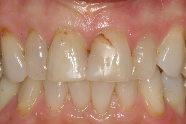            Dental Crowns Case 7 - Before