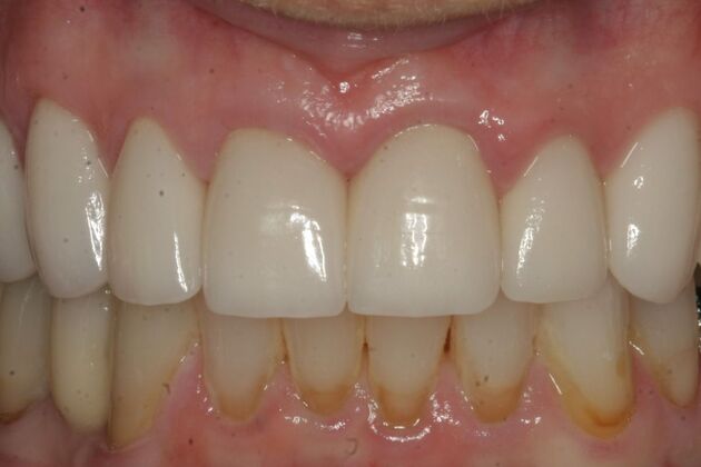            Dental Crowns Case 7 - After