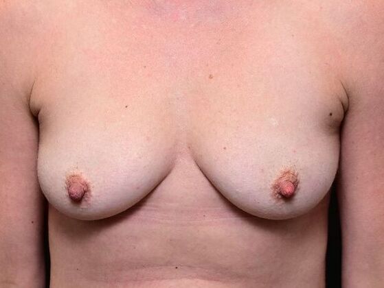 Breast Augmentation Case 17 - Before