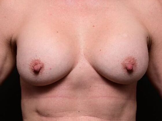 Breast Augmentation Case 17 - After