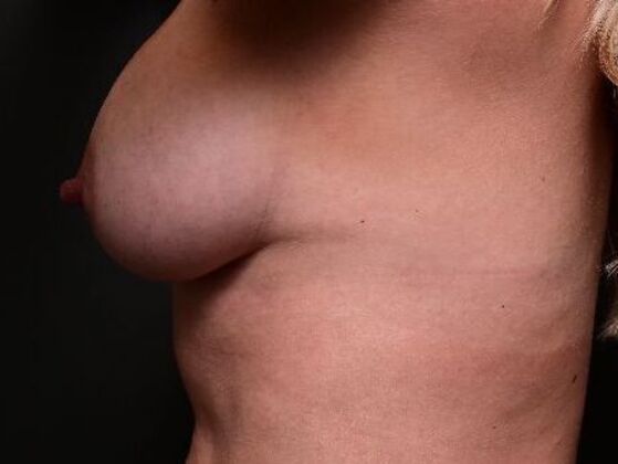 Breast Augmentation: Case 17 - After