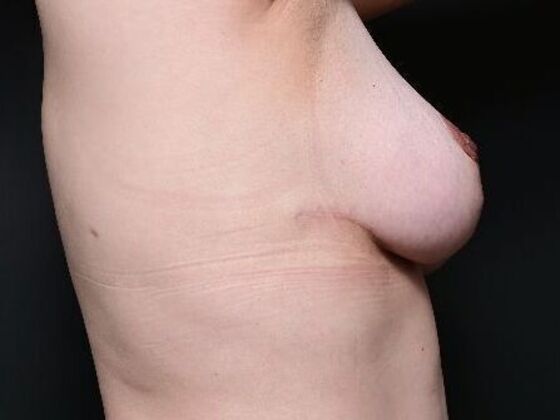 Breast Lift: Case 15 - After