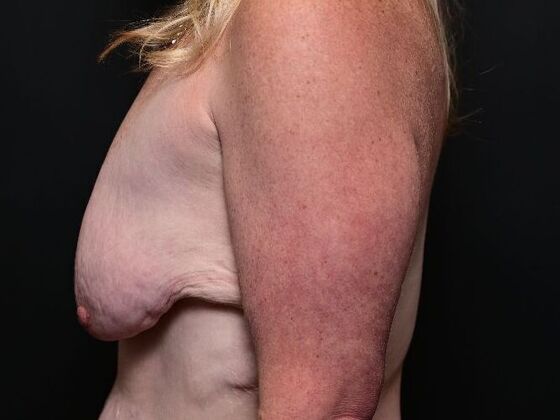 Breast Reduction: Case 9 - Before