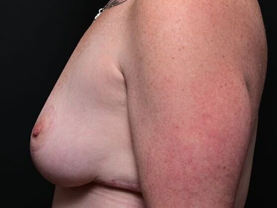 Breast Reduction: Case 9 - After