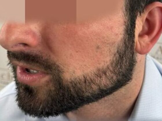 Facial Hair Transplantation: Case 16 - Before