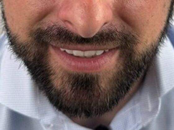 Facial Hair Transplantation Case 16 - After