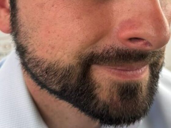 Facial Hair Transplantation: Case 16 - After