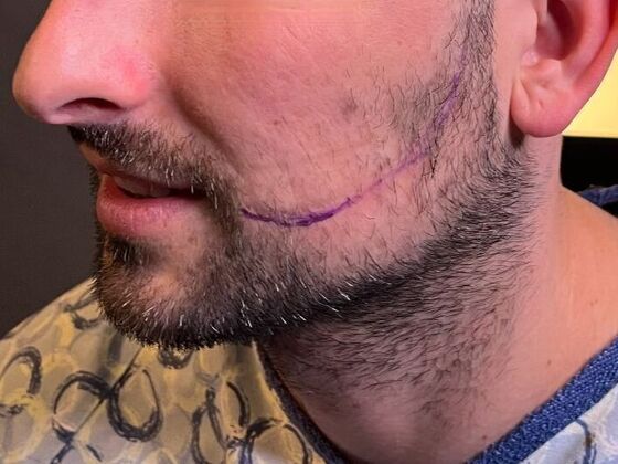 Facial Hair Transplantation: Case 16 - After