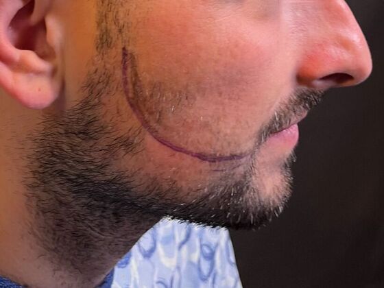 Facial Hair Transplantation: Case 16 - Before