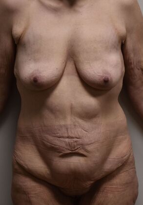 Massive Weight Loss : Case 192 - Before