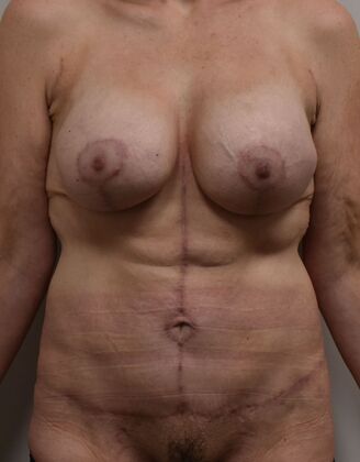 Massive Weight Loss : Case 192 - After