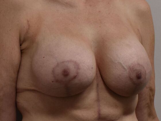 Breast Augmentation w/ Lift: Case 626 - After