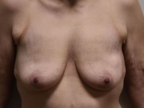 Breast Augmentation w/ Lift: Case 626 - Before