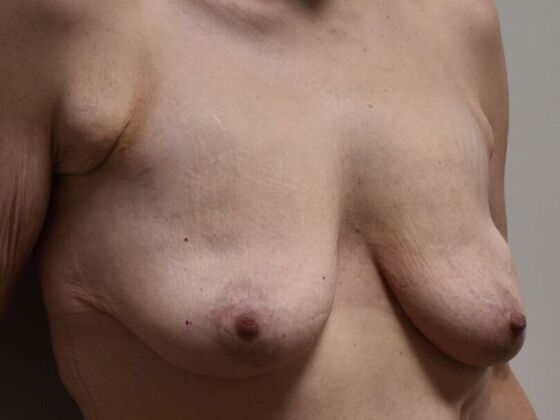 Breast Augmentation w/ Lift: Case 626 - Before