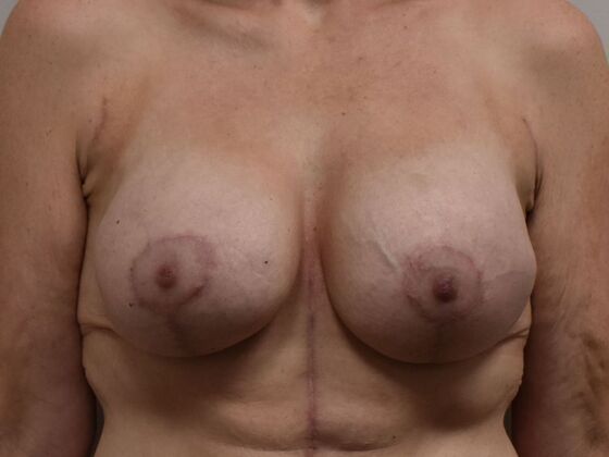 Breast Augmentation w/ Lift: Case 626 - After