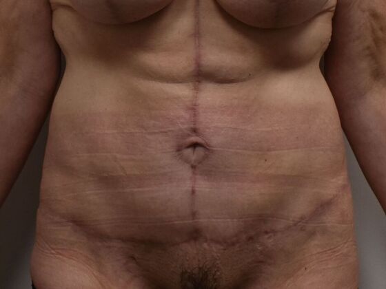 Tummy Tuck (Abdominoplasty): Case 561 - After