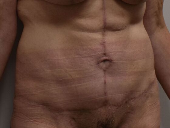 Tummy Tuck (Abdominoplasty): Case 561 - After