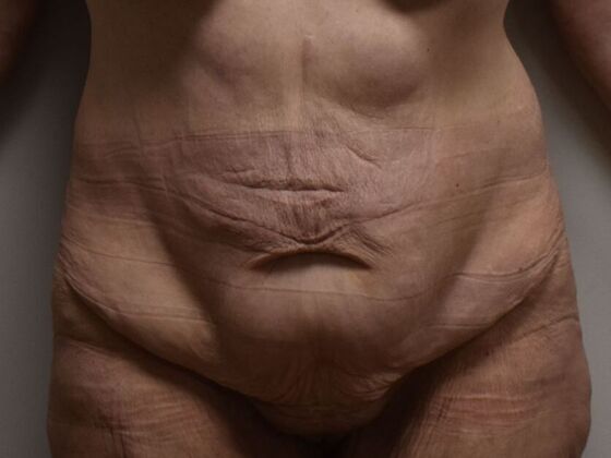 Tummy Tuck (Abdominoplasty): Case 561 - Before