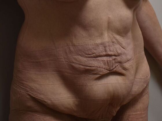 Tummy Tuck (Abdominoplasty): Case 561 - Before