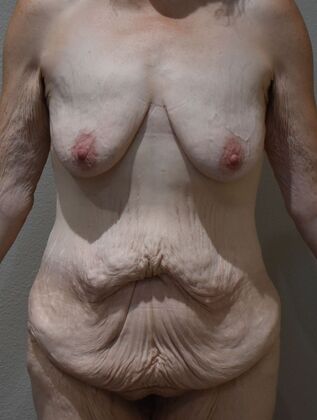 Massive Weight Loss : Case 12 - Before