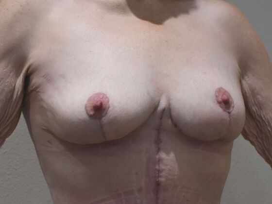 Breast Lift (Mastopexy): Case 256 - After