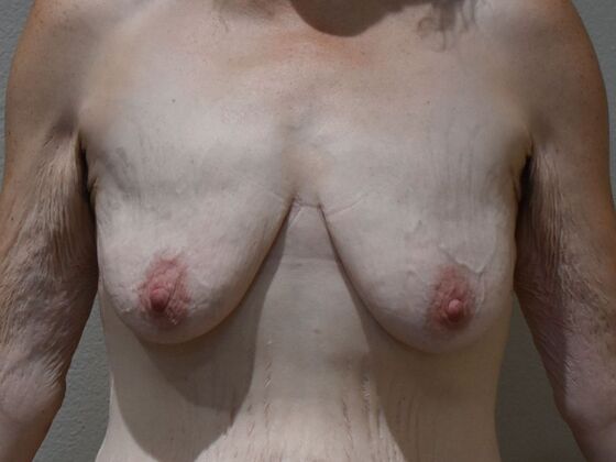 Breast Lift (Mastopexy): Case 256 - Before