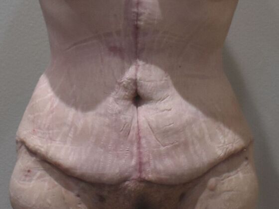 Tummy Tuck (Abdominoplasty): Case 476 - After