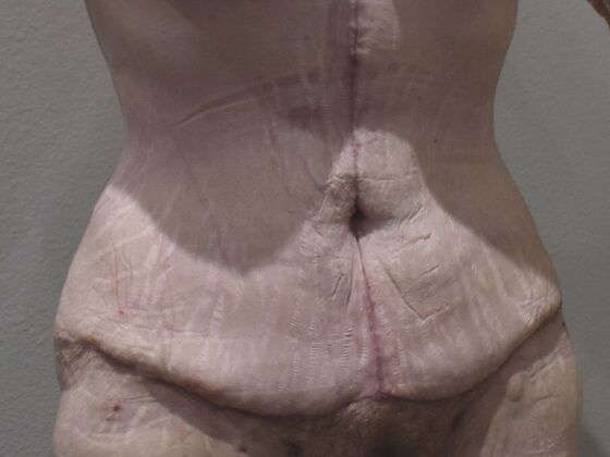 Tummy Tuck (Abdominoplasty): Case 476 - After