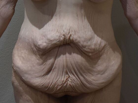 Tummy Tuck (Abdominoplasty): Case 476 - Before