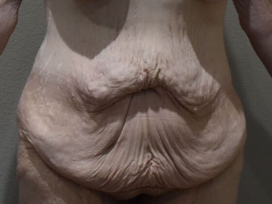 Tummy Tuck (Abdominoplasty): Case 476 - Before