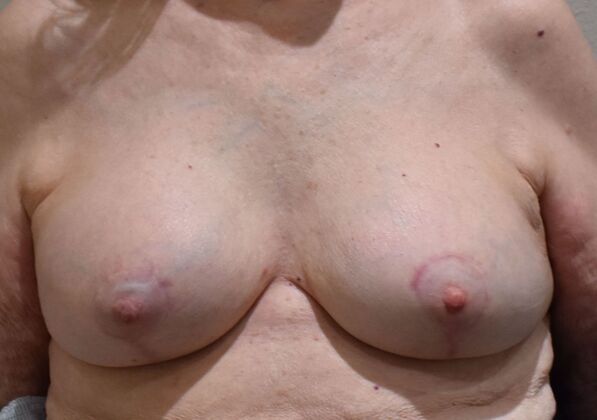 Breast Revision: Case 320 - After