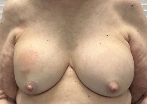 Breast Revision: Case 320 - Before