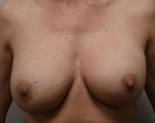 Breast Revision: Case 322 - Before