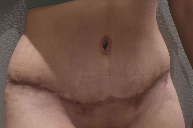 Massive Weight Loss : Case 194 - After