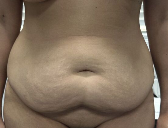Tummy Tuck (Abdominoplasty): Case 562 - Before